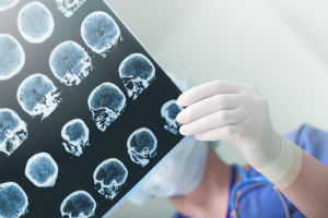 How Much Is A Traumatic Brain Injury Claim Worth?