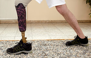 Loss Of Limb Injury Compensation Claims