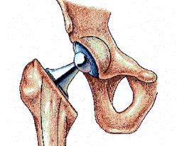 Johnson & Johnson Agrees To Pay $420 Million To Settle Hip Implant Cases